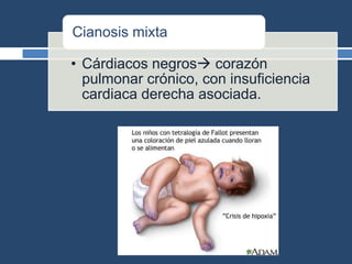 • Cárdiacos negros corazón
pulmonar crónico, con insuficiencia
cardiaca derecha asociada.
Cianosis mixta
 