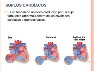 SOPLOS CARDÍACOS
 Es un fenómeno acústico producido por un flujo
turbulento (anormal) dentro de las cavidades
cardiacas o grandes vasos.
 
