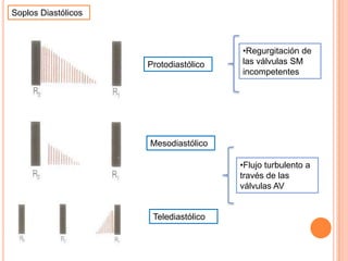 Soplos Diastólicos
Protodiastólico
Mesodiastólico
Telediastólico
•Regurgitación de
las válvulas SM
incompetentes
•Flujo turbulento a
través de las
válvulas AV
 