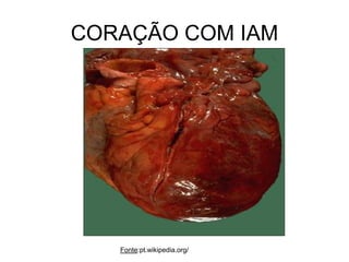 CORAÇÃO COM IAM
Fonte:pt.wikipedia.org/
 