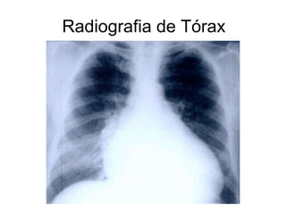 Radiografia de Tórax
 