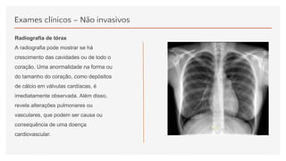 Exames clínicos – Não invasivos
Radiografia de tórax
A radiografia pode mostrar se há
crescimento das cavidades ou de todo o
coração. Uma anormalidade na forma ou
do tamanho do coração, como depósitos
de cálcio em válvulas cardíacas, é
imediatamente observada. Além disso,
revela alterações pulmonares ou
vasculares, que podem ser causa ou
consequência de uma doença
cardiovascular.
 