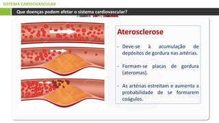 SISTEMA CARDIOVASCULAR
Que doenças podem afetar o sistema cardiovascular?
Aterosclerose
- Deve-se à acumulação de
depósitos de gordura nas artérias.
- Formam-se placas de gordura
(ateromas).
- As artérias estreitam e aumenta a
probabilidade de se formarem
coágulos.
 