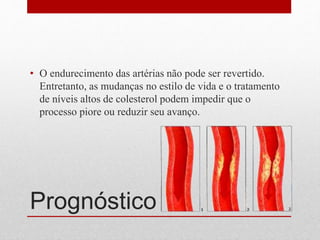Prognóstico
• O endurecimento das artérias não pode ser revertido.
Entretanto, as mudanças no estilo de vida e o tratamento
de níveis altos de colesterol podem impedir que o
processo piore ou reduzir seu avanço.
 