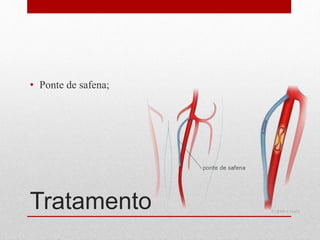 Tratamento
• Ponte de safena;
 