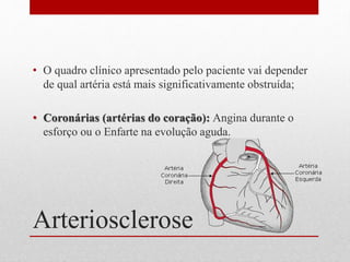 Arteriosclerose
• O quadro clínico apresentado pelo paciente vai depender
de qual artéria está mais significativamente obstruída;
• Coronárias (artérias do coração): Angina durante o
esforço ou o Enfarte na evolução aguda.
 
