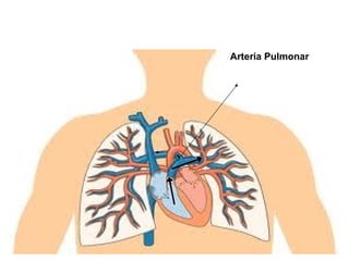 Arteria Pulmonar
 