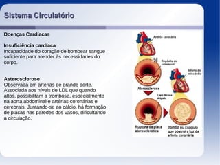 Sistema CirculatórioSistema Circulatório
Doenças Cardíacas
Insuficiência cardíaca
Incapacidade do coração de bombear sangue
suficiente para atender às necessidades do
corpo.
Asterosclerose
Observada em artérias de grande porte.
Associada aos níveis de LDL que quando
altos, possibilitam a trombose, especialmente
na aorta abdominal e artérias coronárias e
cerebrais. Juntando-se ao cálcio, há formação
de placas nas paredes dos vasos, dificultando
a circulação.
 