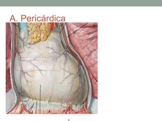 A. Pericárdica
 