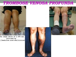 TROMBOSE VENOSA PROFUNDA
 