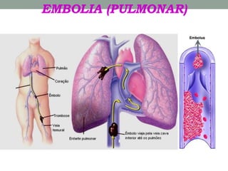 EMBOLIA (PULMONAR)
 