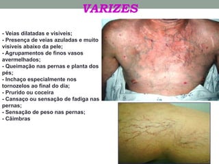 VARIZES
- Veias dilatadas e visíveis;
- Presença de veias azuladas e muito
visíveis abaixo da pele;
- Agrupamentos de finos vasos
avermelhados;
- Queimação nas pernas e planta dos
pés;
- Inchaço especialmente nos
tornozelos ao final do dia;
- Prurido ou coceira
- Cansaço ou sensação de fadiga nas
pernas;
- Sensação de peso nas pernas;
- Cãimbras
 