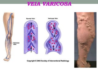 VEIA VARICOSA
 