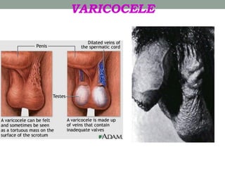 VARICOCELE
 