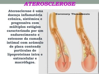 ATEROSCLEROSE
Aterosclerose é uma
doença inflamatória
crônica, sistêmica e
progressiva com
múltiplos estágios
caracterizada por um
endurecimento e
estenose da camada
intimal com acúmulo
de placa contendo
partículas de
lipoproteínas intra e
extracelular e
macrófagos.
 
