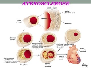 ATEROSCLEROSE
 