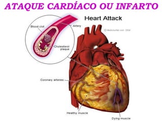 ATAQUE CARDÍACO OU INFARTO
 