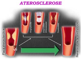 ATEROSCLEROSE
 