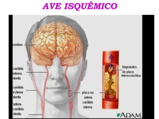 ATEROSCLEROSE
AVE ISQUÊMICO
 