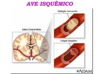 AVE ISQUÊMICO
 