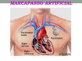 MARCAPASSO ARTIFICIAL
 