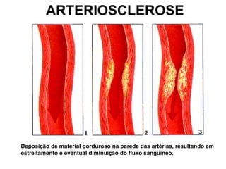 ARTERIOSCLEROSE
Deposição de material gorduroso na parede das artérias, resultando em
estreitamento e eventual diminuição do fluxo sangüíneo.
 