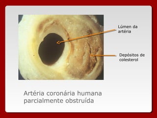 Artéria coronária humana
parcialmente obstruída
Lúmen da
artéria
Depósitos de
colesterol
 