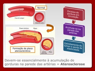 Normal




    Formação da placa
      aterosclerótica



Devem-se essencialmente à acumulação de
gorduras na parede das artérias = Aterosclerose
 