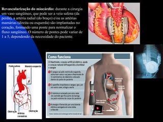 Revascularização do miocárdio: durante a cirurgia
um vaso sangüíneo, que pode ser a veia safena (da
perda), a artéria radial (do braço) e/ou as artérias
mamárias (direita ou esquerda) são implantadas no
coração, formando uma ponte para normalizar o
fluxo sangüíneo. O número de pontes pode variar de
1 a 5, dependendo da necessidade do paciente.
 