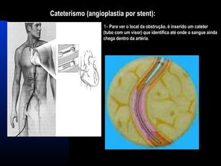 Cateterismo (angioplastia por stent):
1- Para ver o local da obstrução, é inserido um cateter
(tubo com um visor) que identifica até onde o sangue ainda
chega dentro da artéria.
 