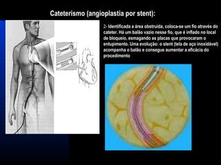 Cateterismo (angioplastia por stent):
2- Identificada a área obstruída, coloca-se um fio através do
cateter. Há um balão vazio nesse fio, que é inflado no local
de bloqueio, esmagando as placas que provocaram o
entupimento. Uma evolução: o stent (tela de aço inoxidável)
acompanha o balão e consegue aumentar a eficácia do
procedimento
 