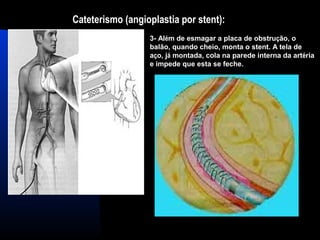 Cateterismo (angioplastia por stent):
3- Além de esmagar a placa de obstrução, o
balão, quando cheio, monta o stent. A tela de
aço, já montada, cola na parede interna da artéria
e impede que esta se feche.
 