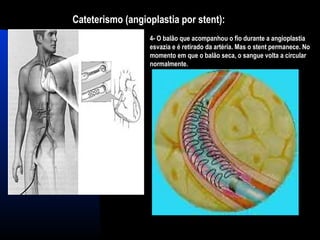 Cateterismo (angioplastia por stent):
4- O balão que acompanhou o fio durante a angioplastia
esvazia e é retirado da artéria. Mas o stent permanece. No
momento em que o balão seca, o sangue volta a circular
normalmente.
 