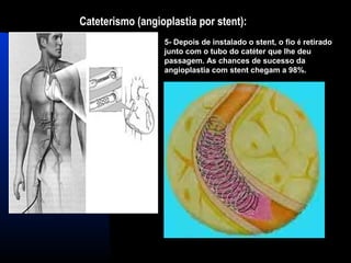 Cateterismo (angioplastia por stent):
5- Depois de instalado o stent, o fio é retirado
junto com o tubo do catéter que lhe deu
passagem. As chances de sucesso da
angioplastia com stent chegam a 98%.
 