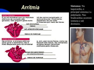 Arritmia Sintomas: Na
taquicardia, o
principal sintoma é a
palpitação. Nas
bradicardias ocorrem
tonturas e até
desmaios.
 