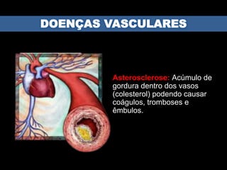 Asterosclerose: Acúmulo de
gordura dentro dos vasos
(colesterol) podendo causar
coágulos, tromboses e
êmbulos.
 
