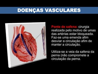 Ponte de safena: cirurgia
realizada pelo motivo de umas
das artérias estar bloqueada.
Faz-se uma emenda afim
desviar a circulação afim de
manter a circulação.
Utiliza-se a veia da safena da
perna (não compromete a
circulação da perna.
 