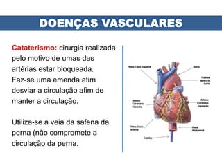 Cataterismo: cirurgia realizada
pelo motivo de umas das
artérias estar bloqueada.
Faz-se uma emenda afim
desviar a circulação afim de
manter a circulação.
Utiliza-se a veia da safena da
perna (não compromete a
circulação da perna.
 