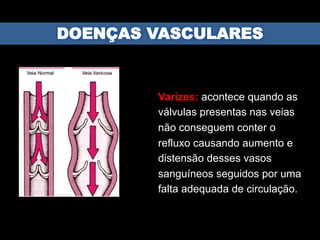 Varizes: acontece quando as
válvulas presentas nas veias
não conseguem conter o
refluxo causando aumento e
distensão desses vasos
sanguíneos seguidos por uma
falta adequada de circulação.
 