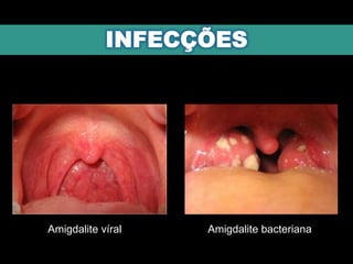 Amigdalite víral Amigdalite bacteriana
 