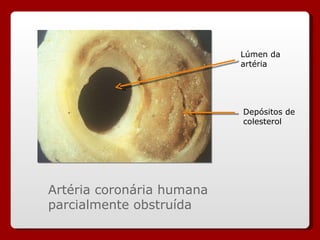 Artéria coronária humana parcialmente obstruída Lúmen da artéria Depósitos de colesterol 