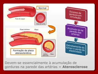 Devem-se essencialmente à acumulação de gorduras na parede das artérias =  Aterosclerose Formação da placa aterosclerótica Normal 