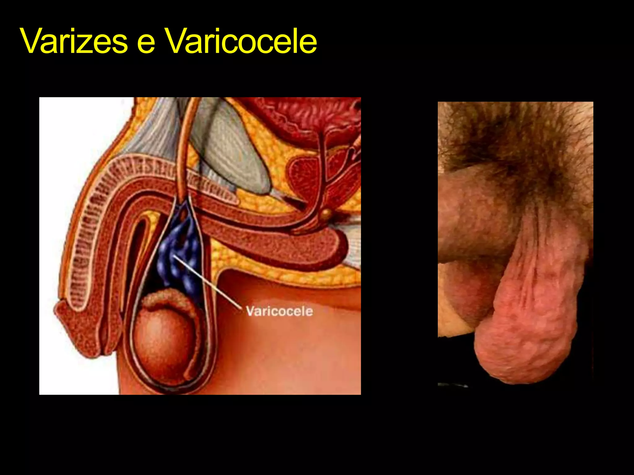 Varizes e Varicocele