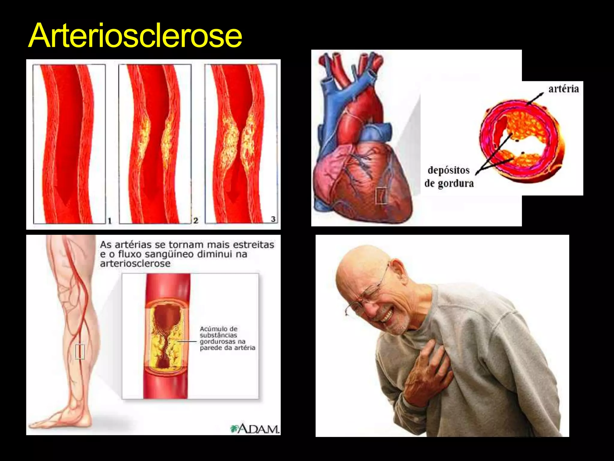 Arteriosclerose