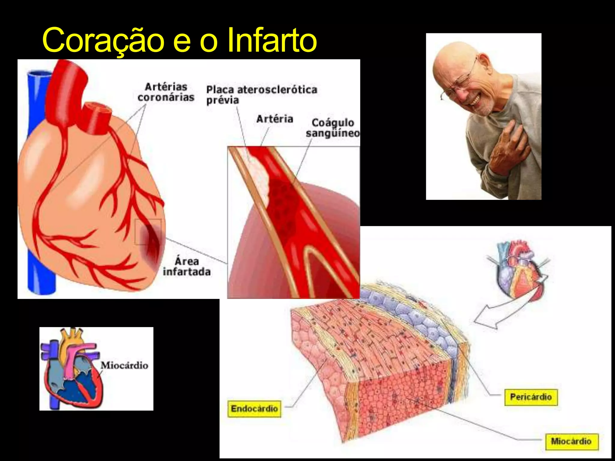 Coração e o Infarto