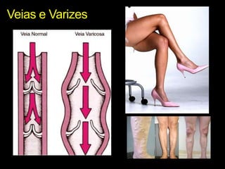 Veias e Varizes