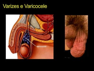 Varizes e Varicocele