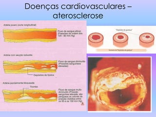 Doenças cardiovasculares –
     aterosclerose
 