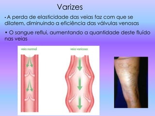 Varizes
•A  perda de elasticidade das veias faz com que se
dilatem, diminuindo a eficiência das válvulas venosas
• O sangue reflui, aumentando a quantidade deste fluído
nas veias
 