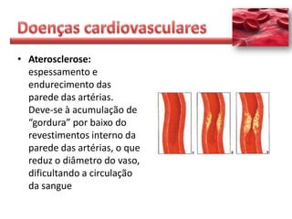 • Aterosclerose:
  espessamento e
  endurecimento das
  parede das artérias.
  Deve-se à acumulação de
  “gordura” por baixo do
  revestimentos interno da
  parede das artérias, o que
  reduz o diâmetro do vaso,
  dificultando a circulação
  da sangue
 